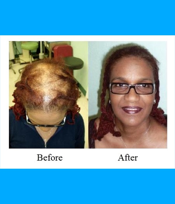  Patient Crown Hair Transplant Cost is $3,500.00