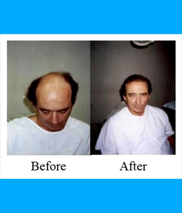  Patient Hair Transplant Cost is $3,800.00