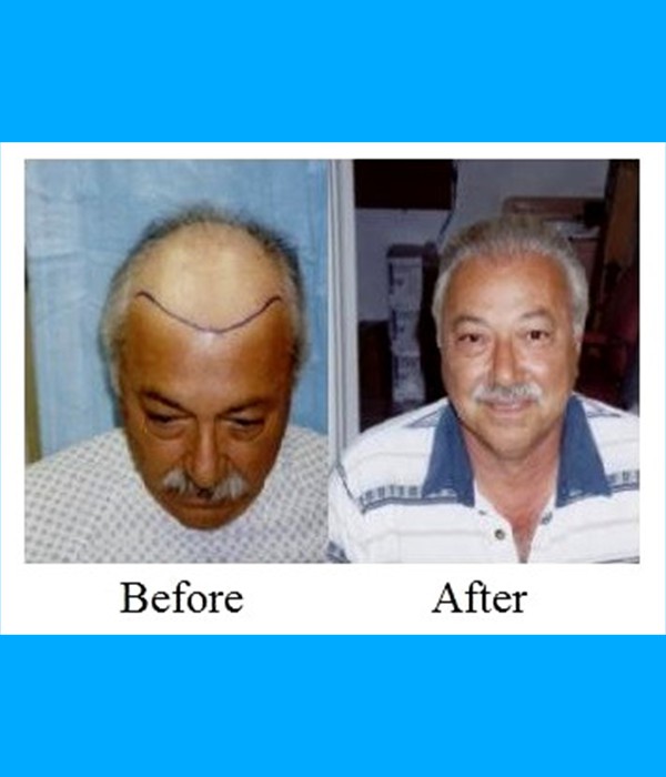  Patient Hair Transplant Cost is $4,000.00