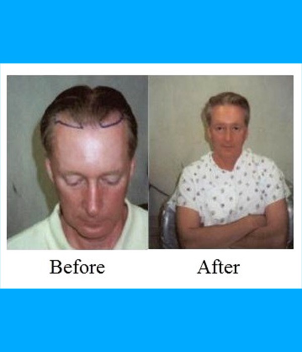  Patient Frontal Hair Transplant Cost is $1,700.00