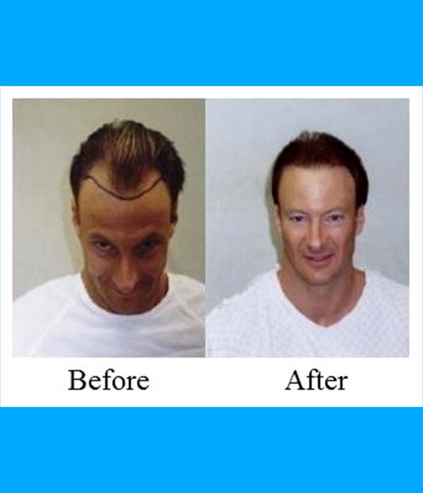 Patient Frontal Hair Transplant Cost is $1,700.00