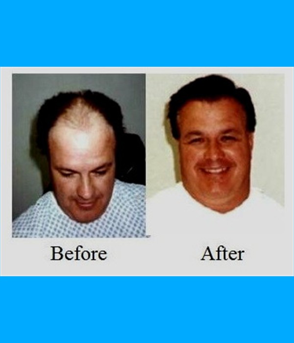  Patient  Hair Transplant Cost is $3,000.00