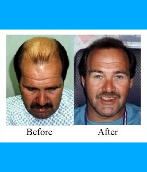  Patient Hair Transplant  Cost is $3,200.00