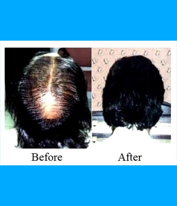  Patient Crown Hair Transplant Cost is $1,500.00