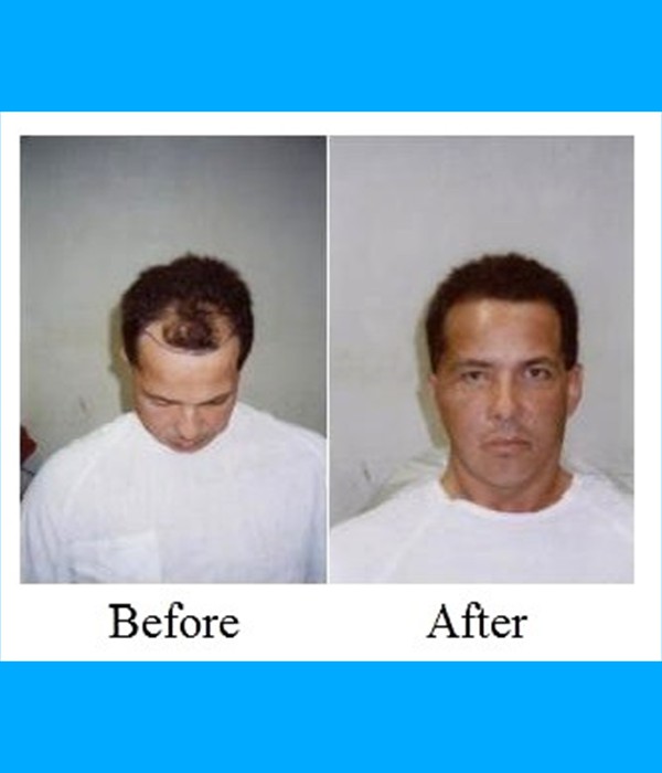 Patient Frontal Hair Transplant Cost is $2,400.00